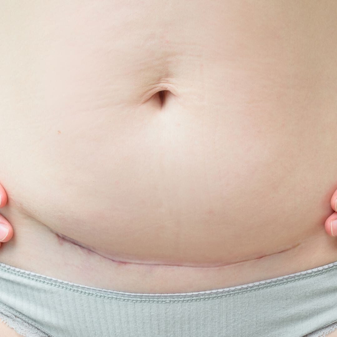 C Section Scar Massage - Walton on Thames, Surrey